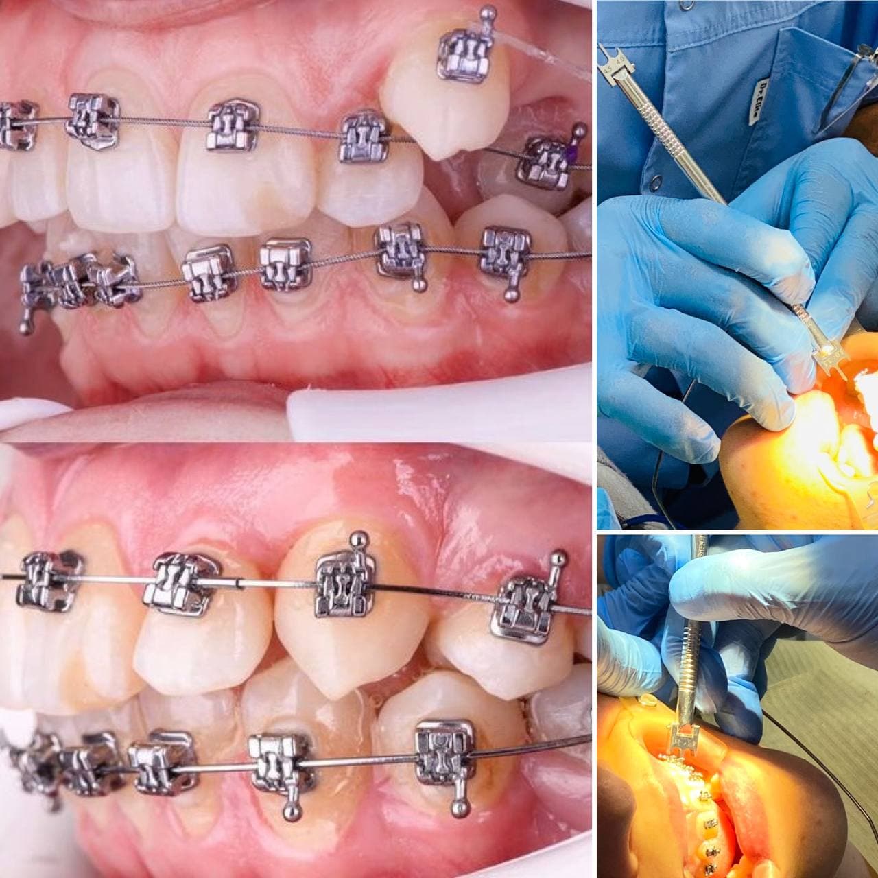 Удаление зубов для брекетов | Статьи | Стоматология Ас-Стом в Санкт-Петербурге