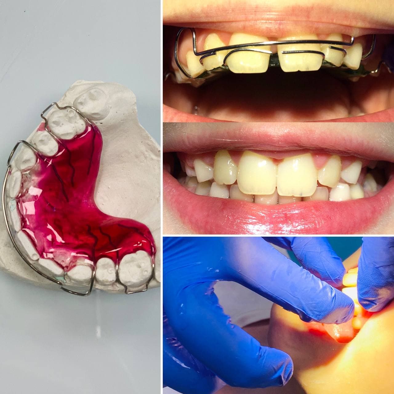 Что такое пластинка на зубы